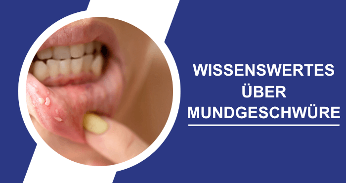 Alles Wissenswerte ueber Mundgeschwuere Titelbild