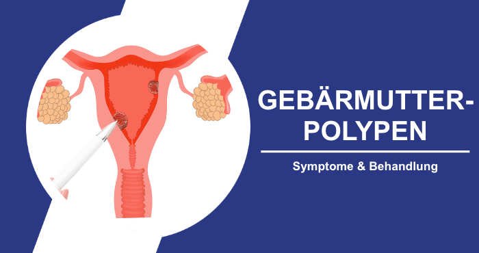 Gebaermutterpolypen Titelbild
